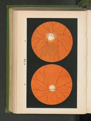Fig. 19 a. Altrophie des Sehnervs nach Entzündung, neuritische Atrophie. Fig 19 b. Atrophie des Sehnervs nach Leitungsunterbrechung durch Fraktur des canalis opticus.