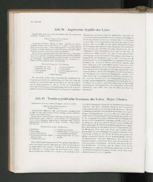 Abb. 94 Angeborene Syphilis der Leber