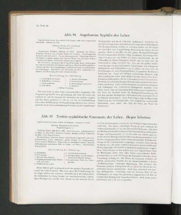 Abb. 94 Angeborene Syphilis der Leber