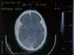 Beidseitige Kraniotomie bei schwerem Schädelhirntrauma