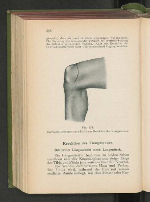 Resektion des Fussgelenkes. Bilateraler Längsschnitt nach Langenbeck.