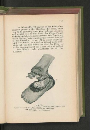 Fig. 91. Enucleatio pedis sub talo. Ablösung des Lappens von der medialen Fläche des Calcaneus.