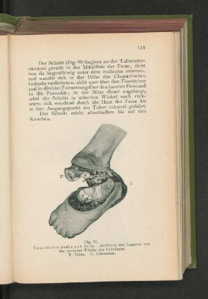 Fig. 91. Enucleatio pedis sub talo. Ablösung des Lappens von der medialen Fläche des Calcaneus.