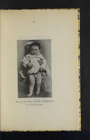 Ernst, Sohn d. Ign. Steinfest in Kiralyhelmez vor der Behandlung.