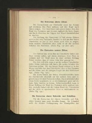 Die Extraction oberer Zähne.