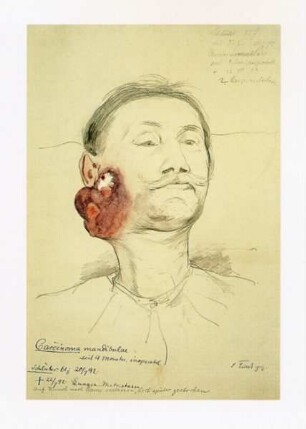 Carcinoma mandibulae. Krankenbildnis Schlüter