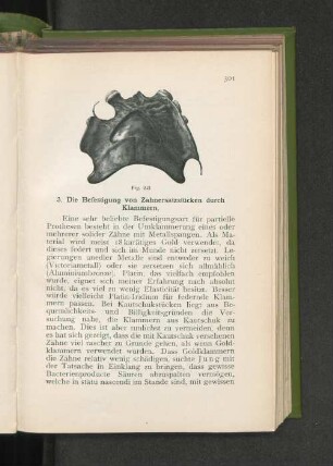3. Die Befestigung von Zahnersatzstücken durch Klammern.