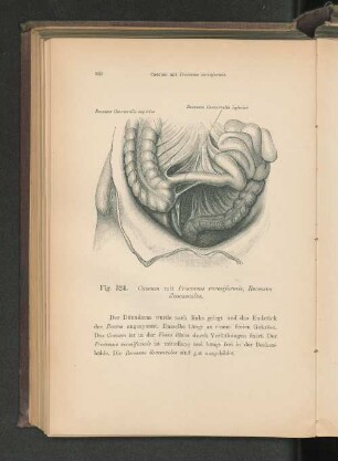 Fig. 324. Caedum mit Processus vermiformis.