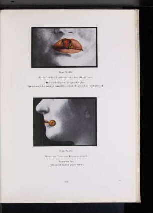 Figur Nr. 337 Krustöse Lues am Lippenwinkel.