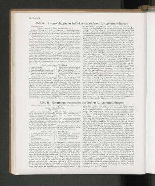 Abb. 47 Hömorrhagische Infarkte im rechten Lungenunterlappen