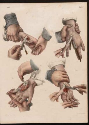 Amputationen an der Hand
