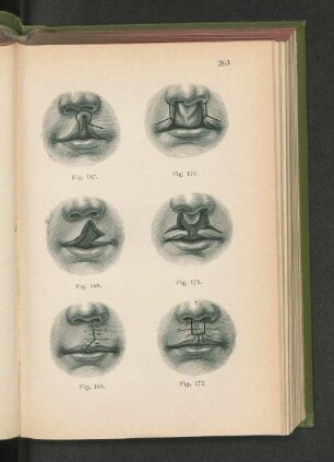 Fig. 167 - 172. Hasenschartenoperationen.