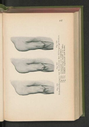 Fig. 122. Längsschnitt nach Langenbeck.