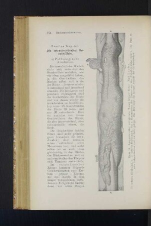 Zweites Kapitel. Die intravertebralen Geschwülste.
