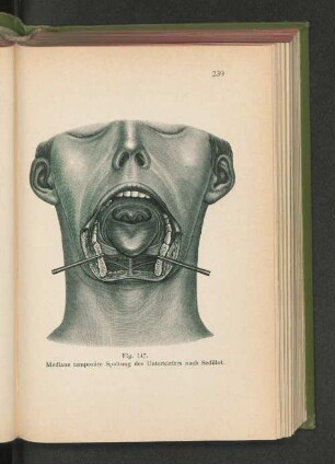 Fig. 147. Mediane temporäre Spaltung des Unterkiefers nach Sedillot.