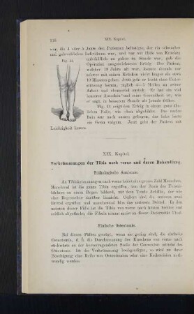 XIX. Kapitel. Verkrümmungen der Tibia nach vorne und deren Behandlung.