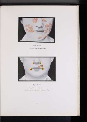 Figur Nr. 343 Impetigo contagiosa durch Staphylokokken hervorgerufen.