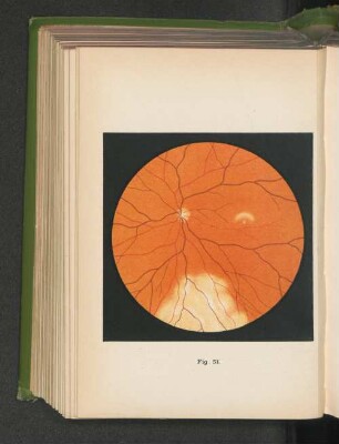 Fig. 51. Trübung der Netzhaut durch Stoss oder Schlag aufs Auge, Berlin'sche Trübung, Commotio retinae.