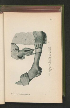 Fig. 56. Amputation des Unterschenkels II. Präparation der Manchette.