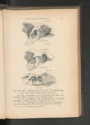 Fig. 147-149. Horizontalschnitte durch das Schläfenbein mit verschieden tiefem Sulcus sigmoideus.
