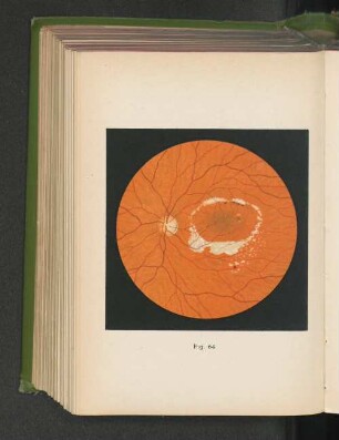 Fig. 64. Retinitis circinata.