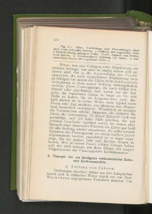 a) Torsion von Zähnen.