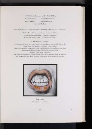 Figur Nr. 195 Stomatitis aphthosa.