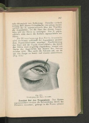 Fig. 174. Blosslegung des Nerv. frontalis.