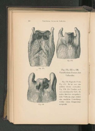 Fig. 174, 175 u. 176. Verschiedene Formen der Valleculae.