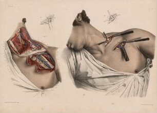 Ligatur der Arteria subclavia und axillaris