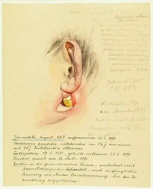 Carcinoma parotidis. Krankenbildnis August Zarnedski