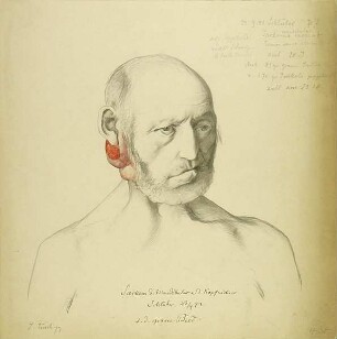 Sarkom d. Mandibula u. d. Kopfnickers. Krankenbildnis Johann Schlüter
