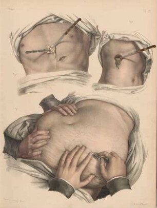 Punktionen des Aszites und von Abzessen in der Leber