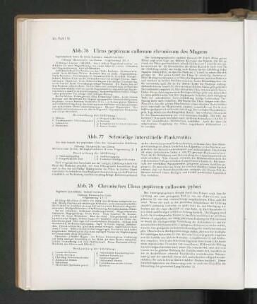 Abb. 77 Schwielige interstitielle Pankratitis