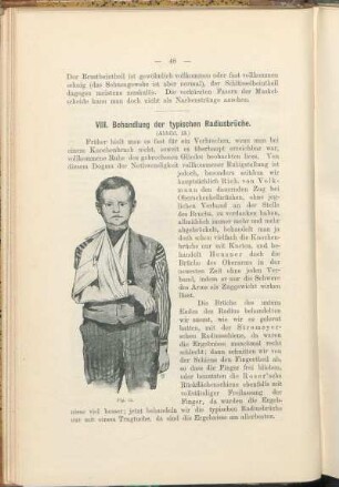 VIII. Behandlung der typischen Radiusbrüche.