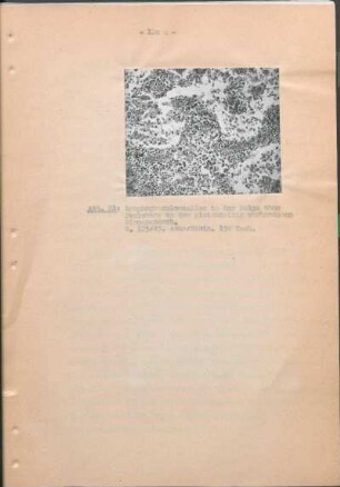 Abb. 21: Lymphogranulomzellen in der Pulpa ohne Beziehung zu dem gleichzeitig vorhandenen Sinuskatarrh.