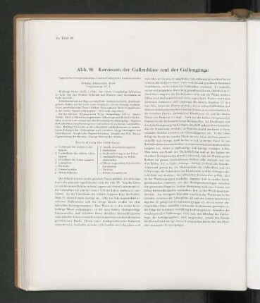 Abb. 98 Karzinom der Gallenblase und der Gallengänge