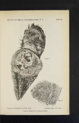 Tafel III. Roemer, Endotheliom der Dura mater.