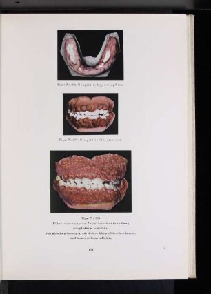 Figur Nr. 206. Gingivitis hypertrophica.