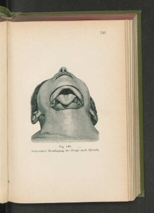 Fig. 149. Submentale Blosslegung der Zunge nach Billroth.
