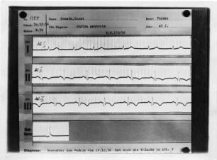 Angina pectoris