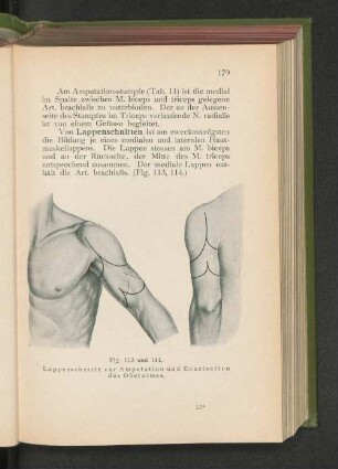 Fig. 113 u. 114. Lappenschnitte zur Amputation und Enucleation des Oberarmes.