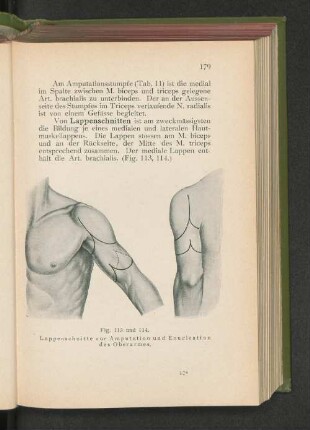 Fig. 113 u. 114. Lappenschnitte zur Amputation und Enucleation des Oberarmes.
