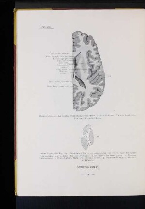 185 Horizontalschnitt der rechten Gehirnhemisphäre durch Nucleus caudatus. Nucleus lentiformis, Thalamus, Capsula interna.