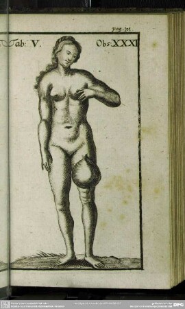 Observatio XXXI. Ein Gewächs am lincken Schenckel weggenommen, so 3. Pfund gewogen