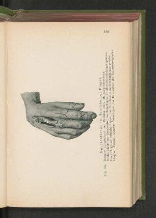 Fig. 104. Enucleationen im Bereiche der Finger.