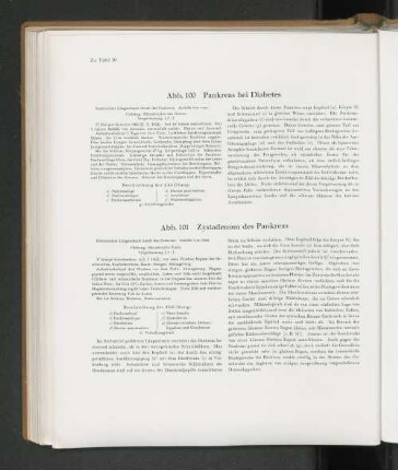 Abb. 100 Pankreas bei Diabetes