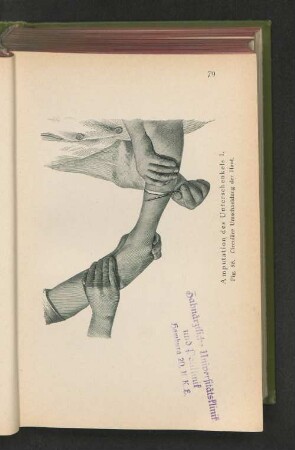 Fig. 55. Amputation des Unterschenkels I. Circuläre Umschneidung der Haut.