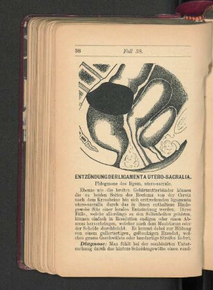 Entzündung der Ligamenta Utero-Sacralia.