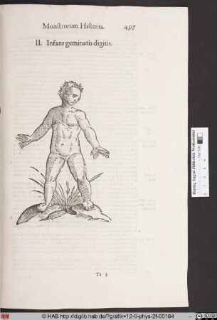 Infans geminatis digitis.